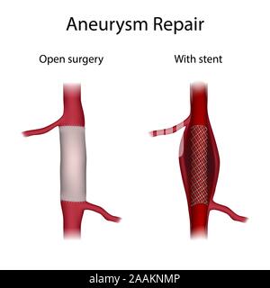 Réparation de l'anévrisme, illustration. Comparaison de la chirurgie ouverte et d'un stent. Banque D'Images