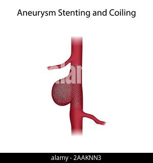 Le stenting de l'anévrisme et l'enroulement, l'illustration. Banque D'Images