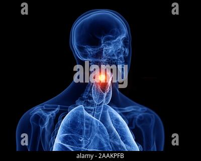 Cancer du larynx, illustration de l'ordinateur. Banque D'Images