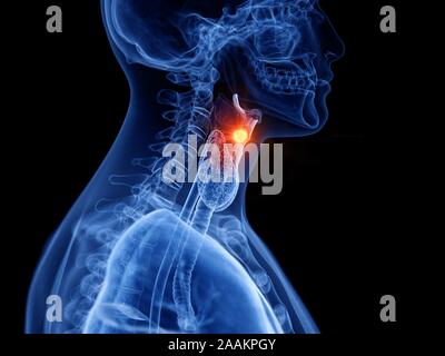 Cancer du larynx, illustration de l'ordinateur. Banque D'Images