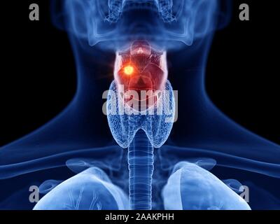 Cancer du larynx, illustration de l'ordinateur. Banque D'Images