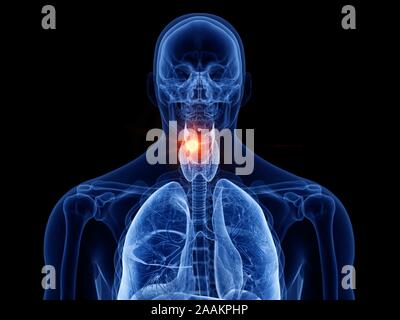 Cancer du larynx, illustration de l'ordinateur. Banque D'Images