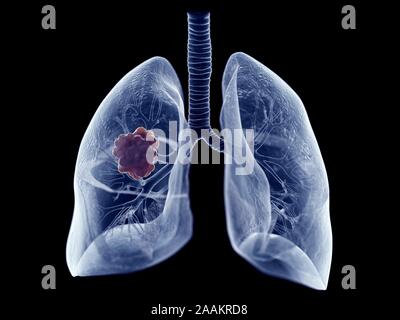 Tumeur pulmonaire, illustration de l'ordinateur. Banque D'Images