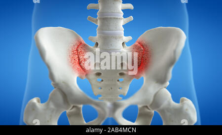 Médicalement en rendu 3d illustration exacte d'une articulation commune iliosacral Banque D'Images