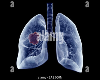 Rendu 3D précis médicalement illustration d'une tumeur pulmonaire Banque D'Images