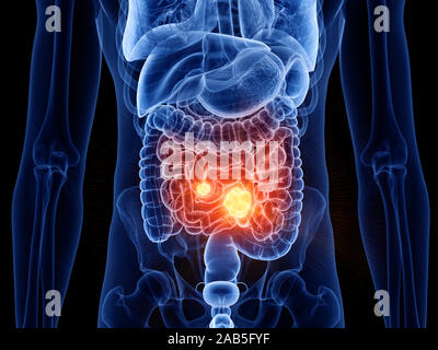 Médicalement en rendu 3d illustration de l'exacte du cancer de l'intestin grêle Banque D'Images