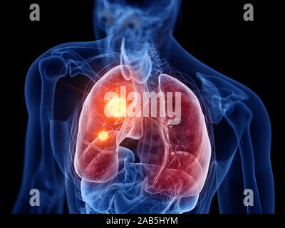 Médicalement en rendu 3d illustration précise du cancer du poumon Banque D'Images