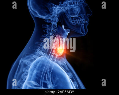 Médicalement en rendu 3d illustration exacte du cancer de la thyroïde Banque D'Images