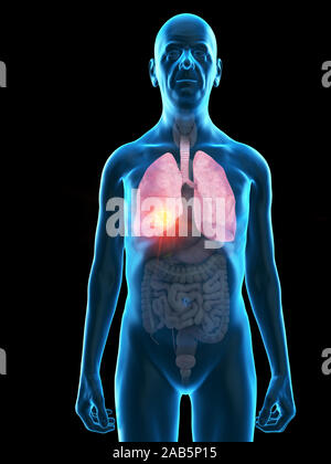 Rendu 3D précis médicalement illustration d'un vieux Mans tumeur pulmonaire Banque D'Images