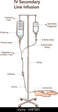 IV perfusion ligne secondaire vector illustration Illustration de Vecteur