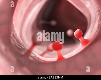 Médicalement en rendu 3d illustration précise de polypes du côlon Banque D'Images