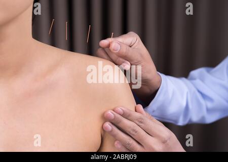 Jeune femme l'objet d'un traitement d'acupuncture pour l'épaule Banque D'Images