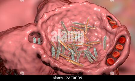 La pneumonie bactérienne. Illustration d'ordinateur de bactéries en forme de bâtonnet (bacilles) dans les alvéoles des poumons, causant un tractus respiratoire inférieur infecti Banque D'Images