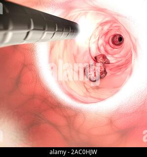 Vue intérieure des parois intestinales. Le cancer colorectal (CCR), cancer de l'intestin, le cancer du côlon ou du cancer rectal. La croissance anormale de cellules Banque D'Images