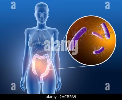 3D illustration montrant la colite à Clostridium difficile, les bactéries dans le gros intestin Banque D'Images