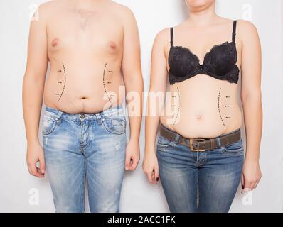 L'homme et la Femme en surpoids et obèses sur le ventre sur un fond blanc. L'abdominoplastie et la liposuccion la chirurgie plastique concept, marqueurs sur l'abdome Banque D'Images
