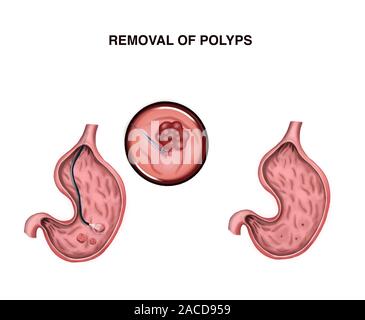 Illustration de l'élimination des polypes de l'estomac Banque D'Images