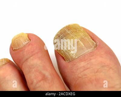 L'onychomycose, mycose des ongles des orteils du pied, in front of white background Banque D'Images