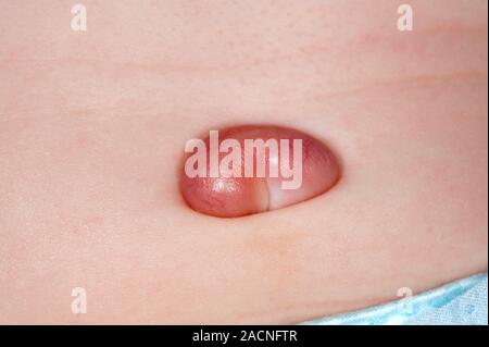 Tissu cicatriciel dans le nombril d'un bébé de 6 mois male patient ...