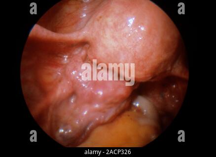 Endoscope (laparoscope) vue d'un varicocèle (veine gonflée ...