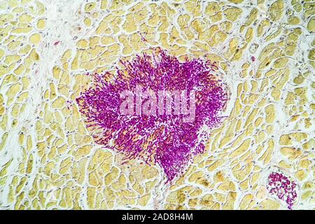 Candida dans le muscle cardiaque d'un malade du SIDA, 200x Banque D'Images