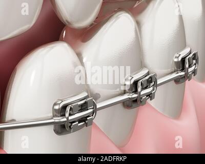 Illustration de l'appareil dentaire sur les dents droites. 3D illustration. Banque D'Images