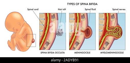 Illustration médicale de la spina bifida avec annotation. Banque D'Images