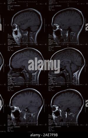 Irm du cerveau humain femelle Banque D'Images