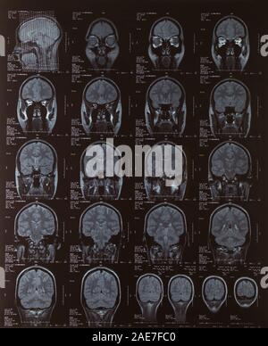 Irm du cerveau féminin Banque D'Images