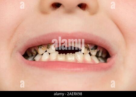 Patient enfant bouche ouverte montrant les dents des caries la carie. Close up de mauvaises dents de bébé. La médecine et les soins dentaires. Banque D'Images