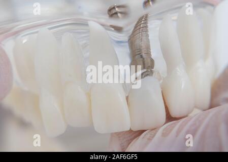 Un modèle de dents avec des implants se trouve sur une table in office Banque D'Images