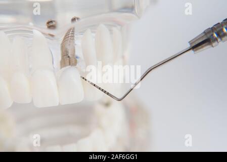 Un modèle de dents avec des implants se trouve sur une table in office Banque D'Images