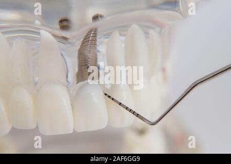 Un modèle de dents avec des implants se trouve sur une table in office Banque D'Images