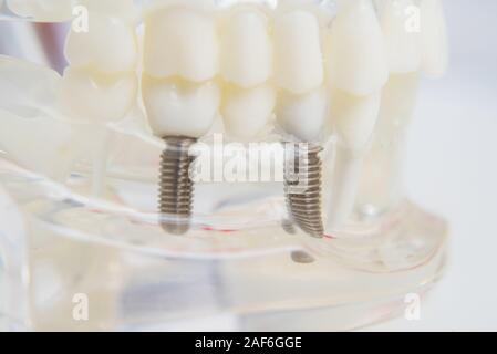 Un modèle de dents avec des implants se trouve sur une table in office Banque D'Images