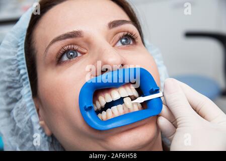 Procédure pour comparer les teintes de blanchiment des dents avant Banque D'Images