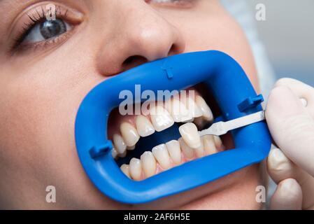 Procédure pour comparer les teintes de blanchiment des dents avant Banque D'Images