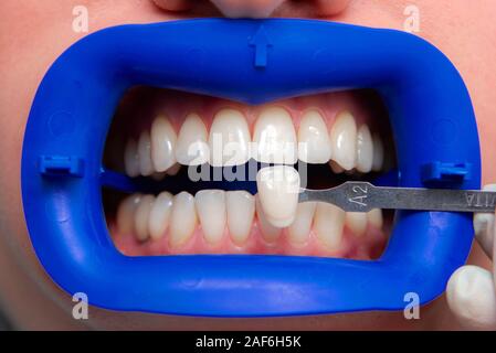 Procédure pour comparer les teintes de blanchiment des dents avant Banque D'Images