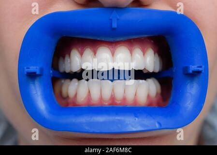 Procédure pour comparer la couleur de dents après le blanchiment Banque D'Images
