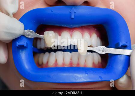 Procédure pour comparer la couleur de dents après le blanchiment Banque D'Images