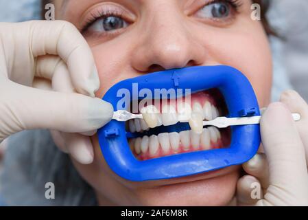 Procédure pour comparer la couleur de dents après le blanchiment Banque D'Images