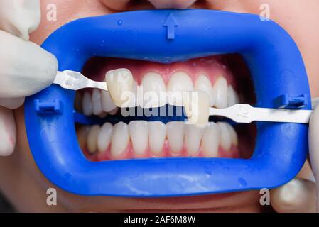Procédure pour comparer la couleur de dents après le blanchiment Banque D'Images