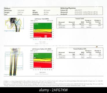 Balayage de la densité des os de l'avant-bras gauche et femur gauche des femmes de race blanche âgés de 80 ans. Banque D'Images