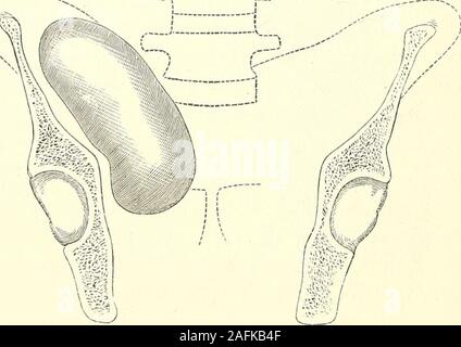 . Le diagnostic, la pathologie et le traitement des maladies des femmes, y compris le diagnostic de grossesse. rrounding les extrémités des trompes de Fallope et les ovaires. * Fig. 6.5 Salons aperçu des efiusion (à droite de l'utérus) Dans un caselately au University College Hospital. 500 PATHOLOGIE ET LE TRAITEMENT. Ils plaident pour un intra-péritonéale presque exclusivement de siège, theinflammation l'argument poursuivis étant le même qu'en consultation au siège de l'hémorragie dans les zones péri-utérines.hsematocele avec péritonite aiguë de la cavité pelvienne à la suite d'injuriesof les organes génératifs pendant Banque D'Images