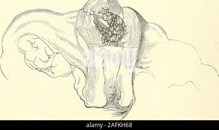 . Le diagnostic, la pathologie et le traitement des maladies des femmes, y compris le diagnostic de grossesse. engorgé ou encombré, état d'theuterus, ovaires, et organes adjacents, dans la plupart des cas par hyperses-thesla des pièces en question, et par des perturbations, d'variouskinds et degrés, d'autres fonctions de l'organisme. Il est, dans «certaine sens, analogue à l'oestrus en bas les animaux, thepresence de la menstruation est une indication que la femme iscapable d'être imprégné, mais la femme diffère d'theseanimals à cet égard, qu'elle est capable d'être imprégné, non pas au moment duri Banque D'Images