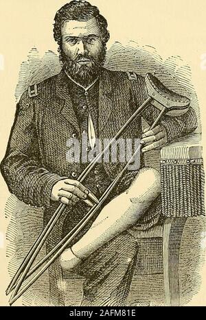 . Les principes et la pratique de la chirurgie. PirogofFs. moignon après une amputation Pirogoff, l'opération ayant été fait byDr. Leale, agissant alors Assistant-Surgeon U. S. A. Kg. 158.. 24 Kesull Pirogofis d'une amputation. 370 L'AMPUTATION DE LA JAMBE. Les amputations de la jambe. L'amputation de la jambe dans la continuité.-Dans le tiers inférieur de l'amputation theleg circulaire devrait, en général, d'avoir la préférence.Pour faire cette opération, que ce soit par le biais de la jambe ou de la cuisse, J'ai pratiqué la méthode suivante oflate :- le couteau, au lieu de faire le circuit complet du membre dans un droit à Aline Banque D'Images