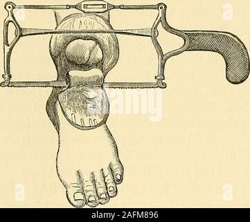 . Les principes et la pratique de la chirurgie. PIROGOFF S'amputation. 3G9 PirogofPs pour permettre le fonctionnement de l'adaptation d'un artificialfoot. Dans le bois d'accompagnement-cut est vu l'apparence de la Fig. 157.. PirogofFs. moignon après une amputation Pirogoff, l'opération ayant été fait byDr. Leale, agissant alors Assistant-Surgeon U. S. A. Kg. 158. Banque D'Images