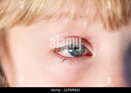 Libre de l'irritation des yeux injectés de rouge - conjonctivite. Banque D'Images