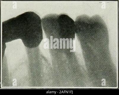 . Électro-dentaire therapeutics. Fig. 155.-C, modèle 1 et 2 avant le traitement, 14 ans plus tard. Le cas C, rapporté à la p. 240, est celui dans lequel exten-sive pyorrhée aux symptômes constitutionnels accompanyingit existait, les poches sur la bouche des aspects de la maladie parodontale incisives prolongée à 295 près de l'apex, chaque symptôme d'chronicpyorrhea existait. Lorsque les dents ont été rentrés à la posi-tion du schéma p. 241 qu'ils étaient tellement vague qu'il theycould déplacé vers l'avant une distance d'environ 5 mm. Sans. Fig. 156.-numériquement le 29 janvier 1907, touchant une prise osseuse. L'os Banque D'Images