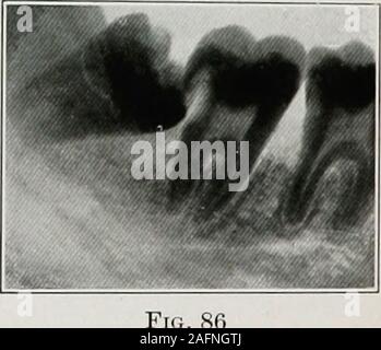 . Électro-dentaire therapeutics. Fig. 85 Fig. 85 et 86.-Sur les dents de sagesse inférieures Boston.. Prises par J. J. Lowe, l'absorption des racines des dents voisines et de caries de même identificateur n'est pas rare et n'a pas pu être déterminé par withany clinique seul diagnostic de certitude. L'ar-ray est anindispensable moyen d'établir la vérité dans ces cas. L'UTILISATION DES RAYONS X EN MÉDECINE DENTAIRE 175 Dans les cas d'inflammation des tissus qui entourent la dent de sagesse inférieure animpacted qui présente une conditionsimulating l'ankylose, et décisions nécessaires d'extraction, theshape et la position de la racine de la Banque D'Images