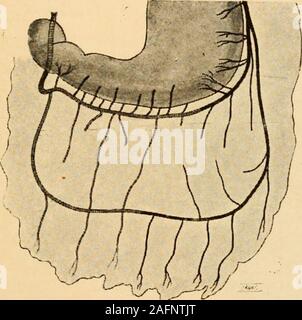 . Pot du médico-chirurgicale de l'abdomen. peut-pariéto colique de ligament. Dans certains cas, sa partie haute seule persists. Il alorsquun nexiste repli, tendu de la paroi latérale de labdomen à langle sous-hépatique, et connu sous le nom de ligament phrénico-coliquedroit ligament suspenseur uo de langle droit. Ainsi donc le côlon ascendant se trouve fixé à la paroi dorsale delabdomen par deux adhérences. En dedans, cest la limite de coa-lescence de son mésentère primitif avec la paroi, ligament mésen-térico-colique ; en dehors, cest la coalescence du reliquat du diver-ticule droit, ligament Banque D'Images
